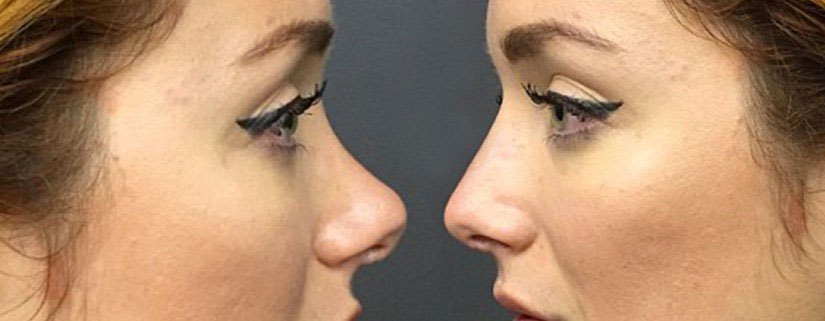 Would YOU have a non-surgical nose job?